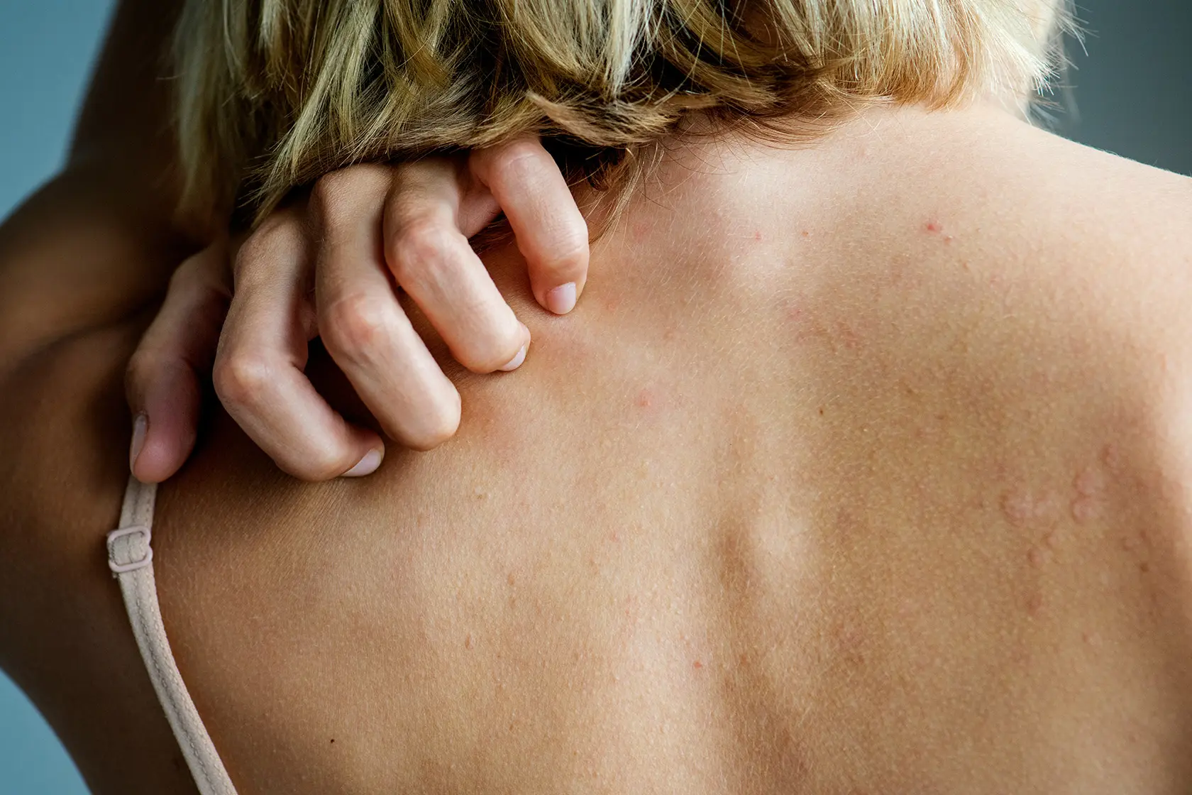 Headergrafik Allergie