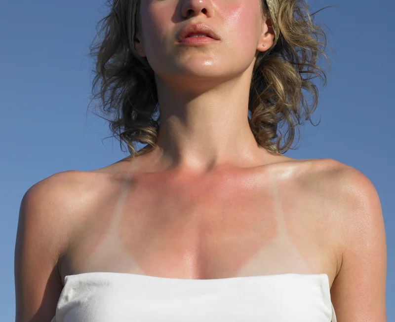 Erste Hilfe bei Sonnenbrand