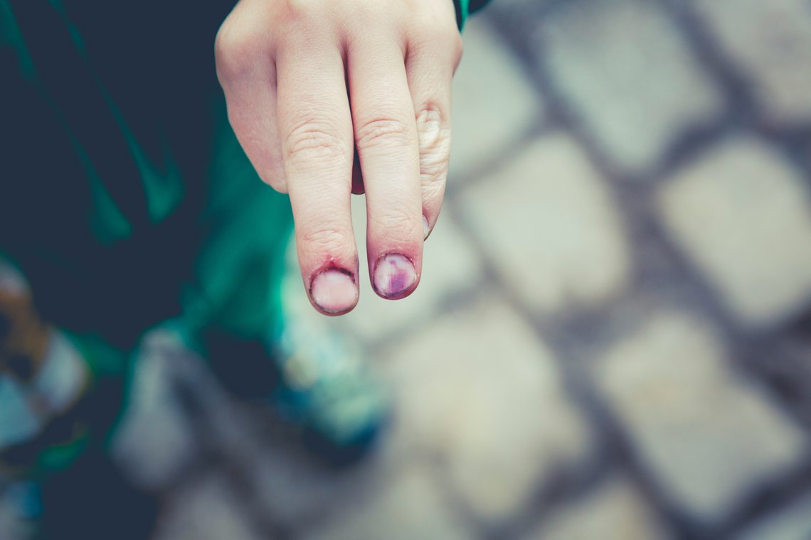 Zwei Finger mit eingerissener, entzündeter Nagelhaut und einem blau verfärbten Fingernagel.