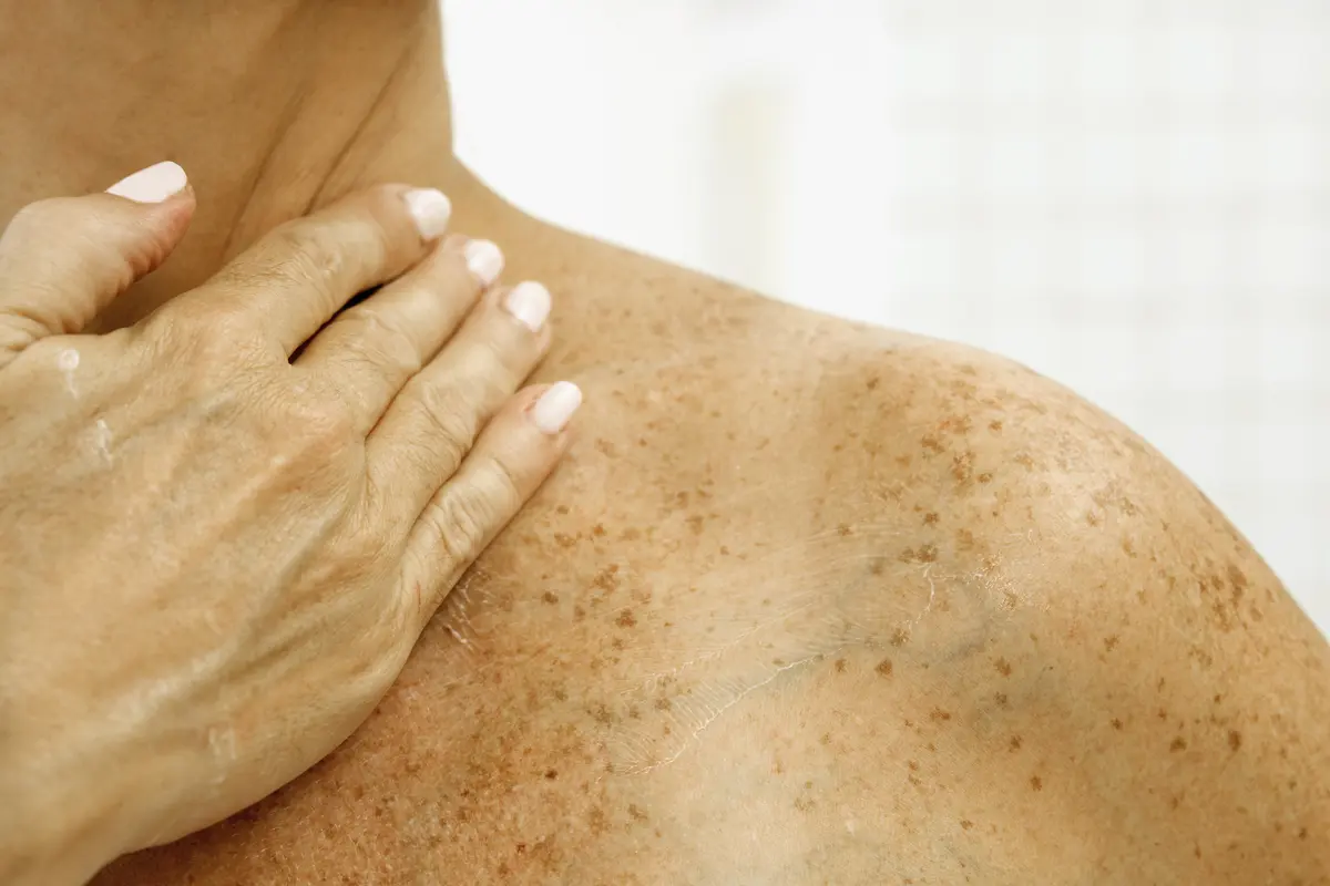 Hexylresorcinol: Wirkstoff gegen Pigmentflecken