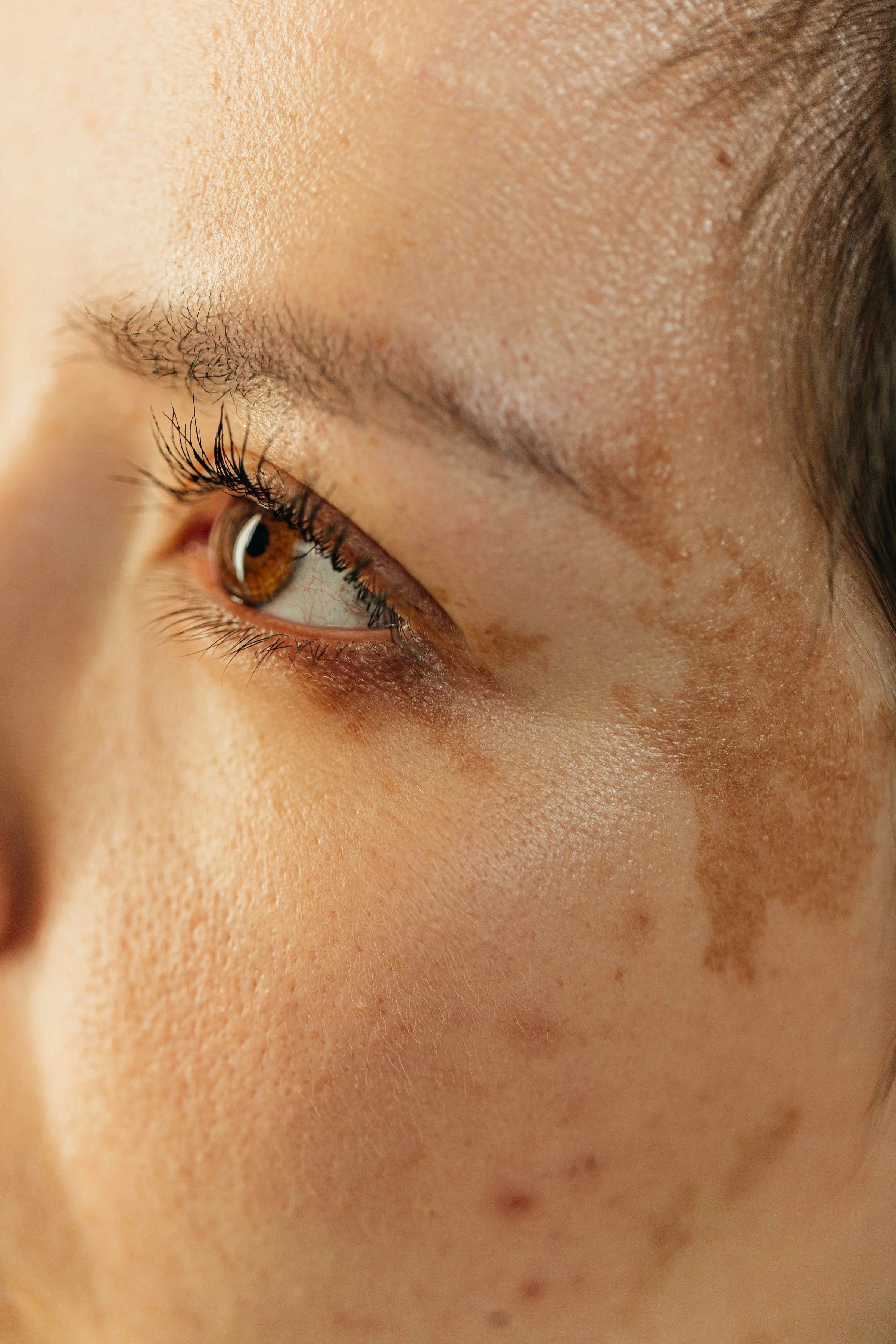 Nahaufnahme der Augen- und Wangenpartie mit bräunlichen Altersflecken und Pigmentierung auf heller Haut.