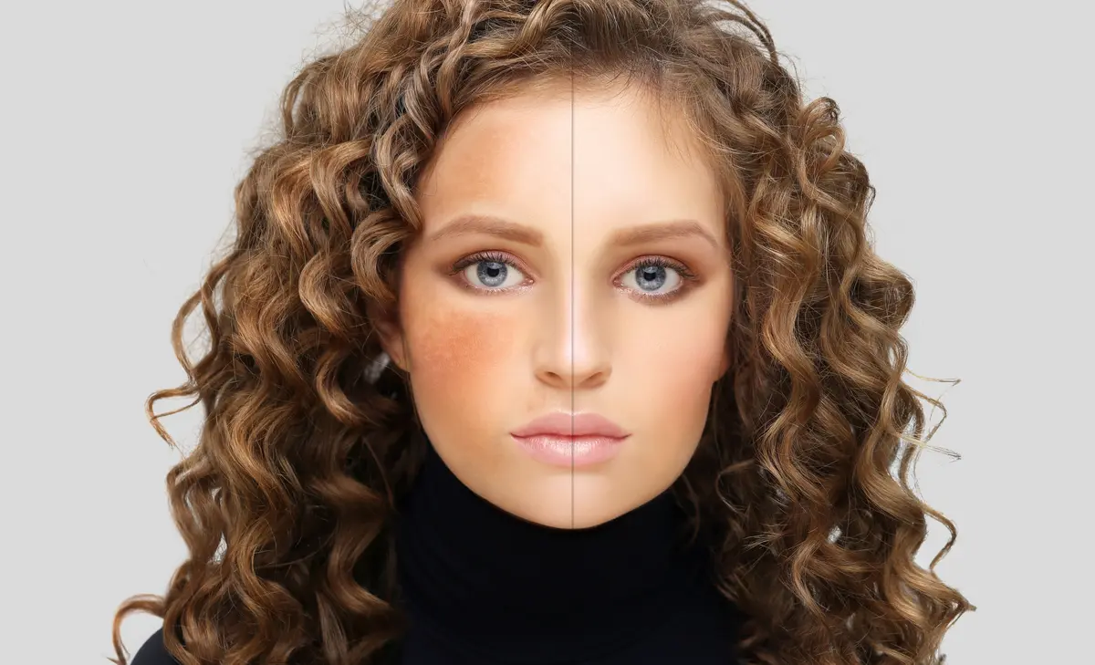 Junge Frau mit Hyperpigmentierungen auf der rechten Gesichtshälfte