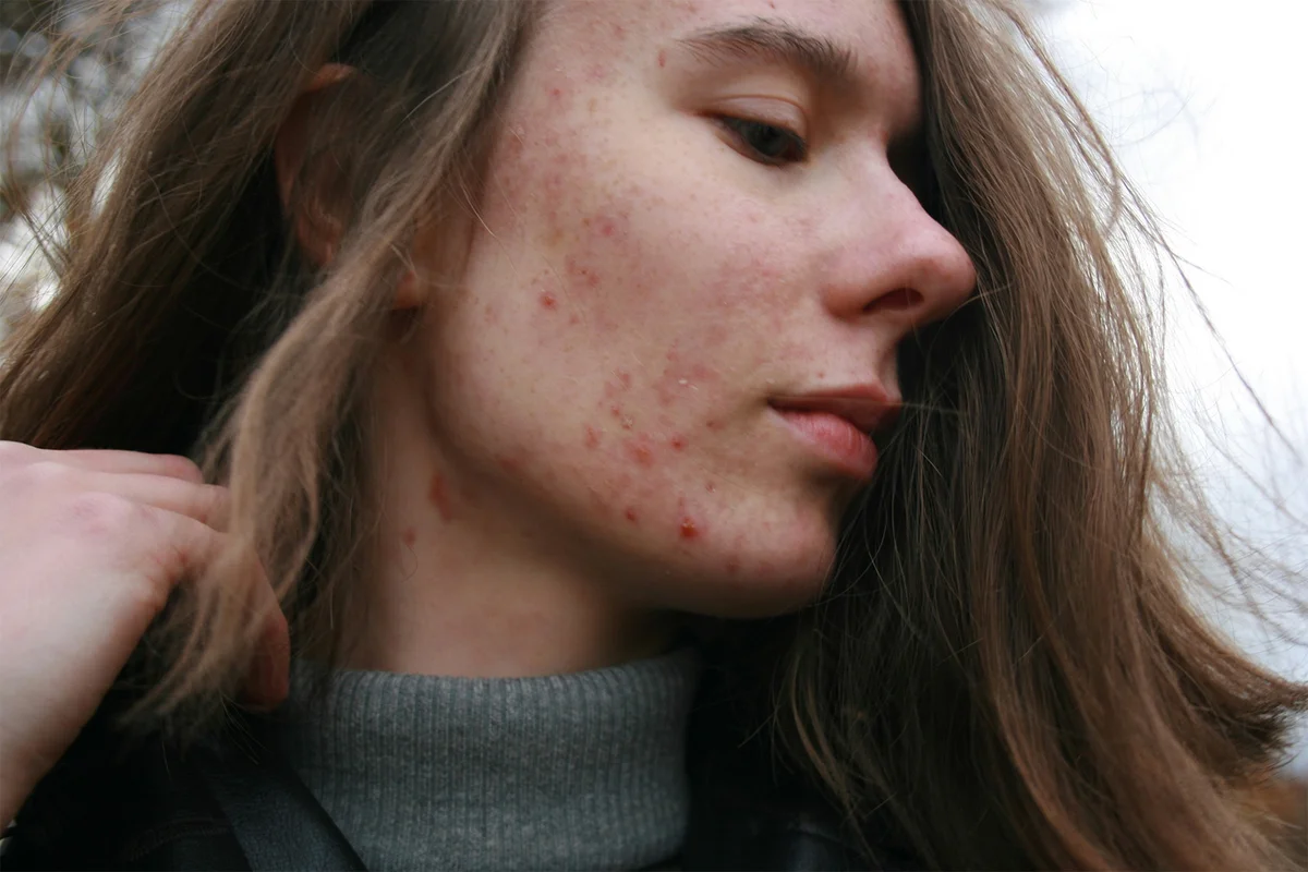 Headergrafik Benzoylpreoxid