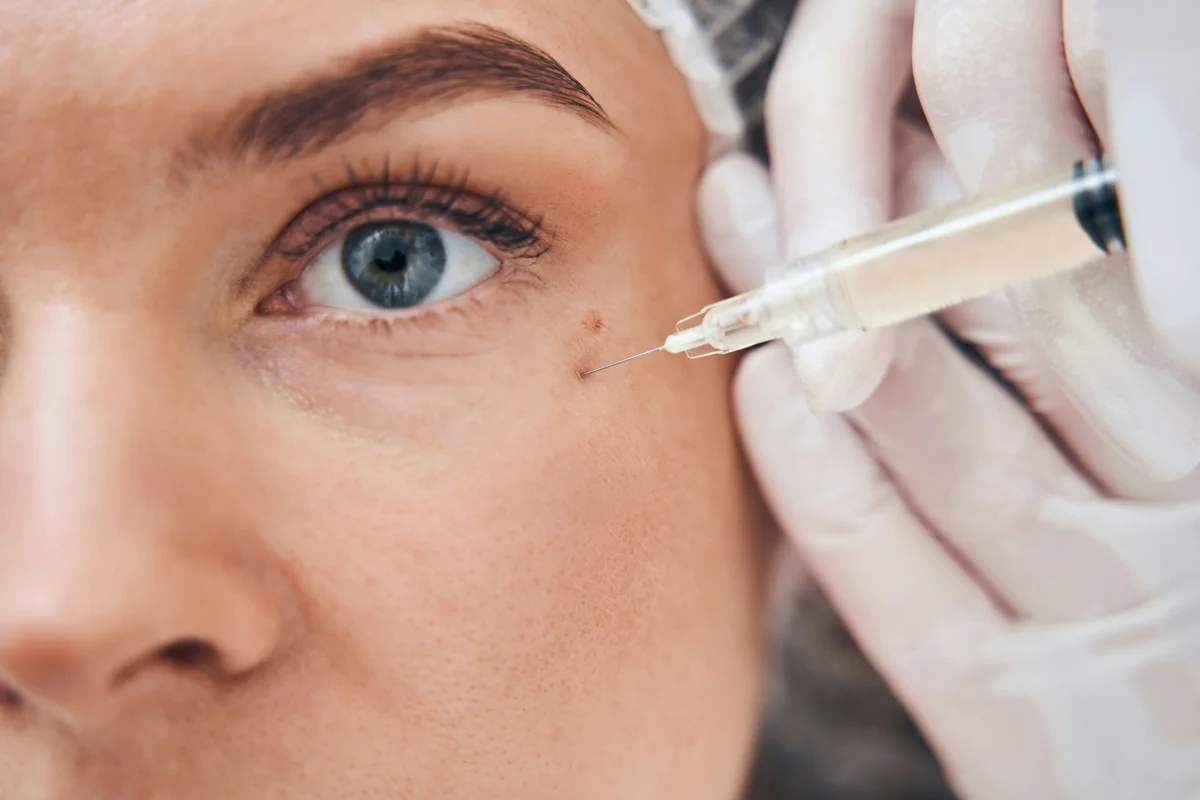 Ein Arzt setzt mit behandschuhten Händen eine Hyaluron-Injektion unter dem Auge einer Frau