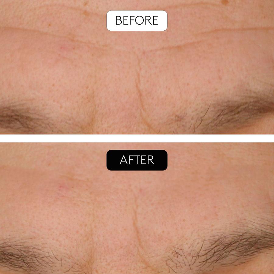 Close-up Stirnbereich, vorher-nachher Aufnahme